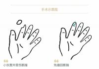 你知道吗？不少人体“零件”都可寄养再植